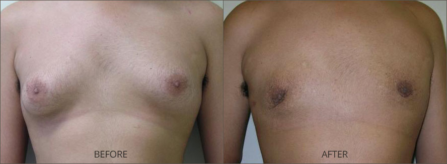 Before and after skin rejuvenation