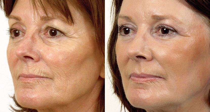 before and after laser facelift wrinkles