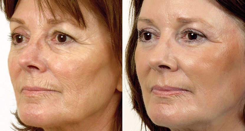 Laser Facelift Dr Kara Plastic Surgery