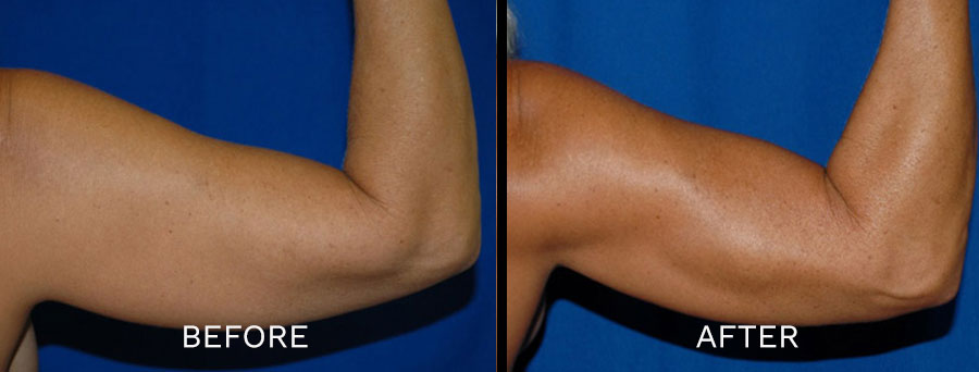 Arm Liposuction: Are the Results Permanent?