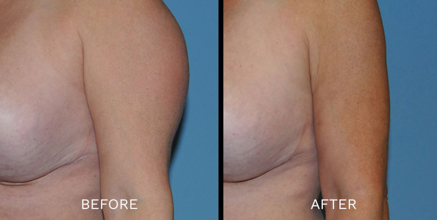 SmartLipo Toronto Before & After Gallery