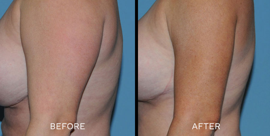 Toronto Liposuction Clinic - See Costs & Before/Afters!