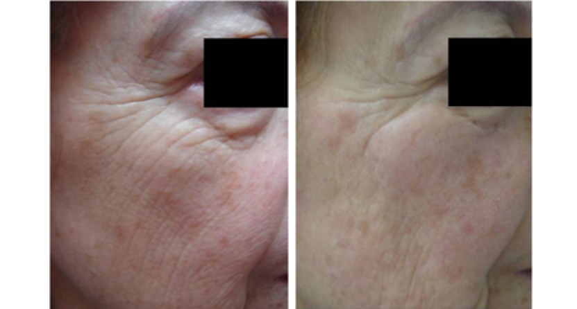 Before and after skin rejuvenation