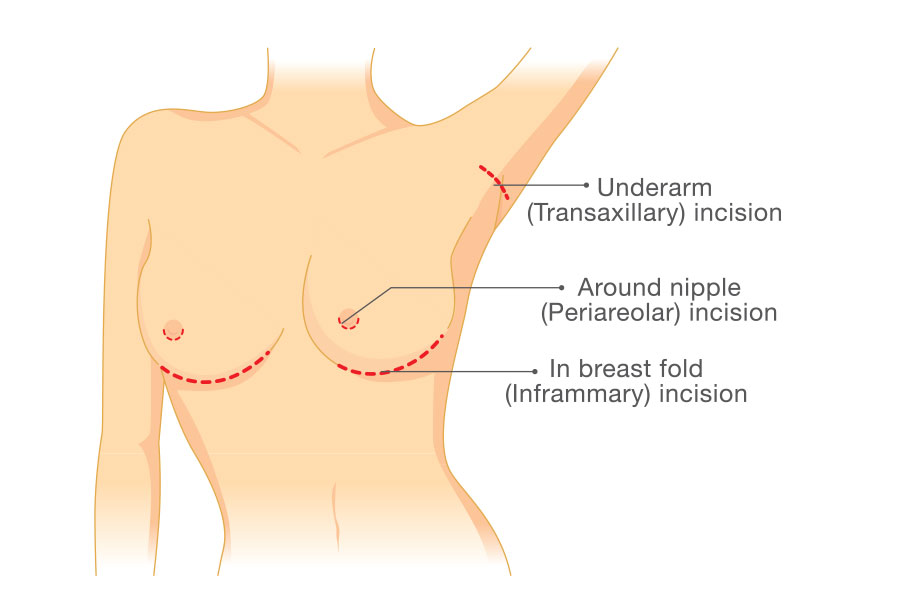 Breast implant incision placement