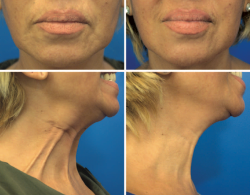 Before and after Botox neck rejuvenation and Nefertiti Lift.