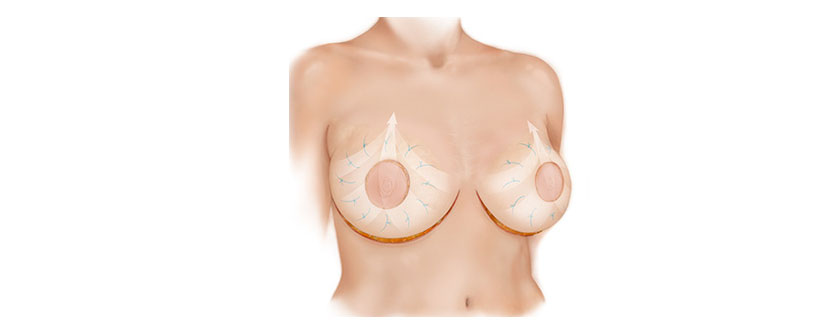 Diagram of Bellesoma breast lift technique.