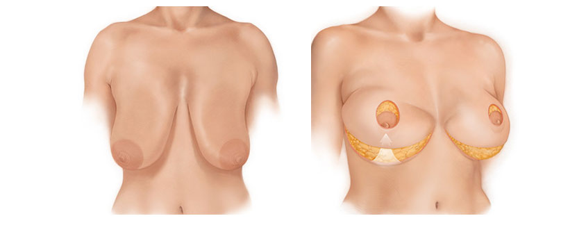 Diagram of Bellesoma breast lift technique.
