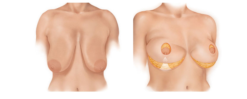 Lollipop Breast Reduction (Short-Scar Breast Reduction) in Ashburn, VA -  NOVA Plastic Surgery and Dermatology