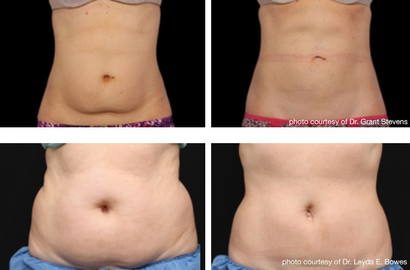 CoolSculpting Fat Freezing Flanks