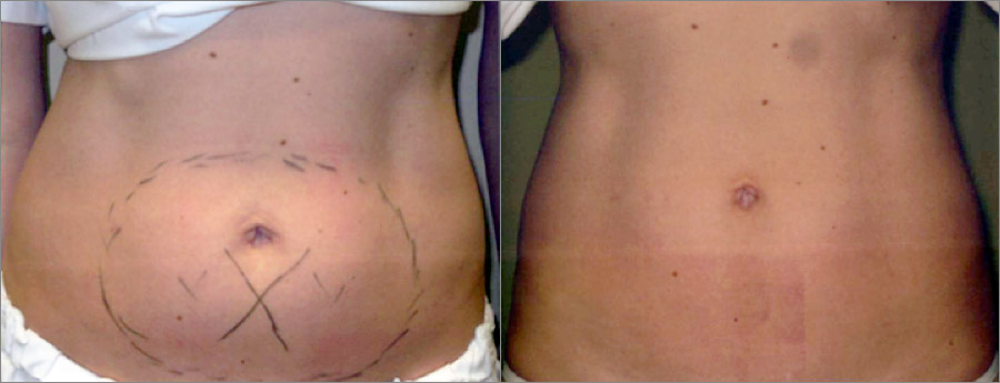 Before After Coolsculpting