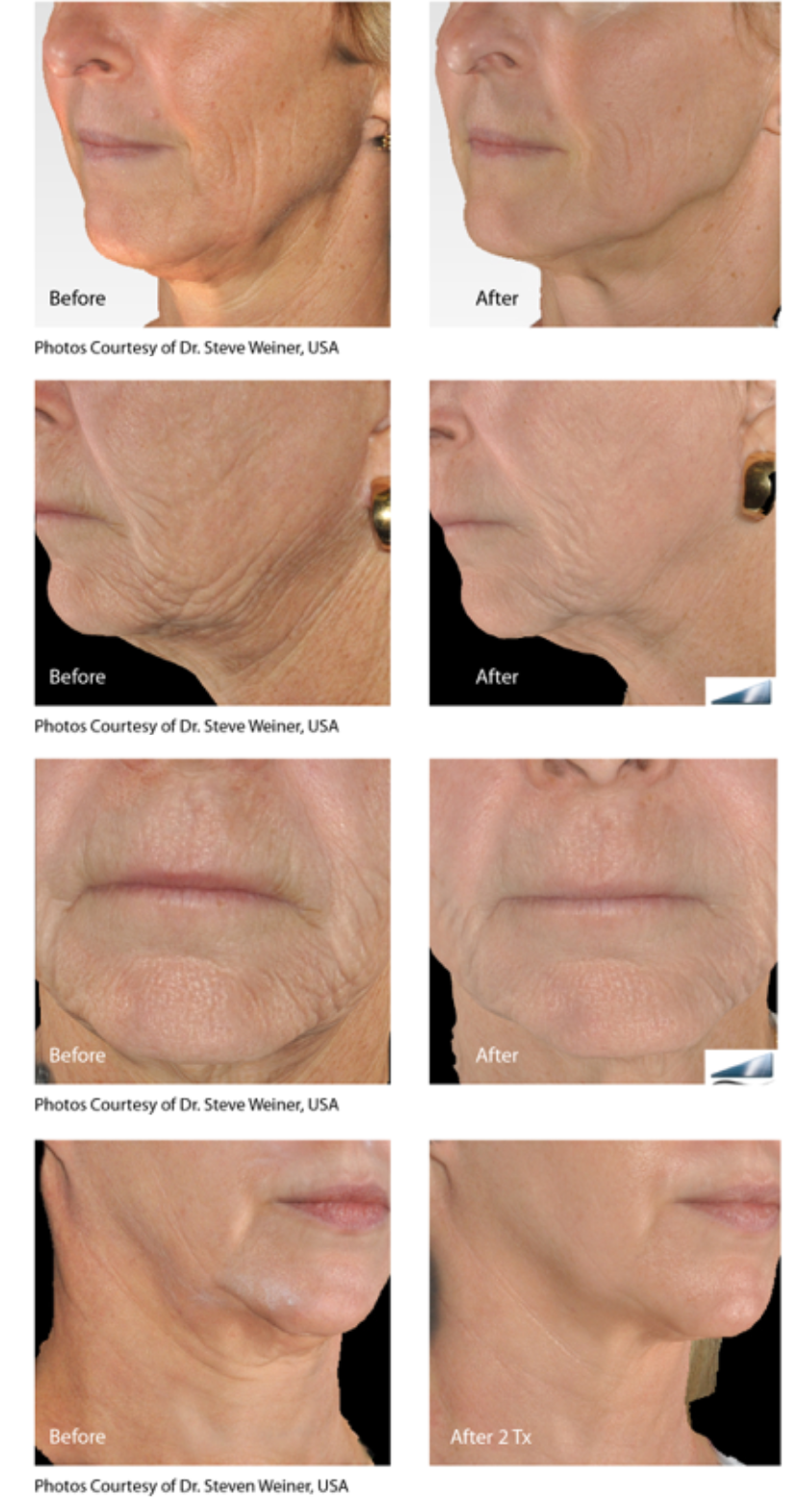 Infini skin tightening on the face.