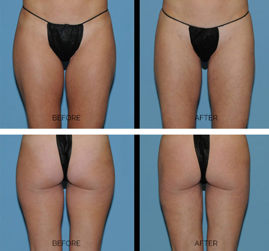 Study Finds Liposuction on Hips and Thighs Safe, Effective