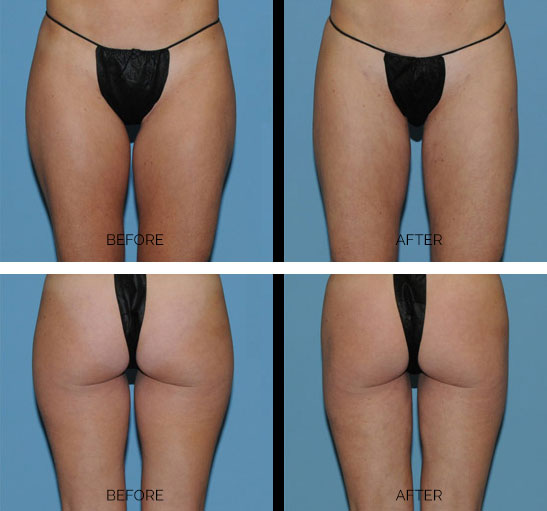 Liposuction Body Contouring - Toronto Cosmetic Surgery