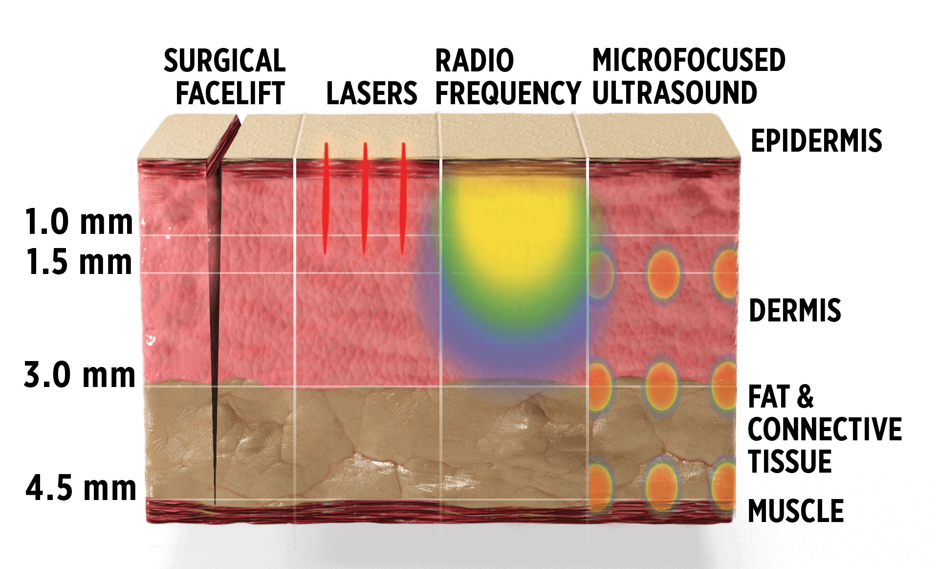 ultherapy diagram toronto